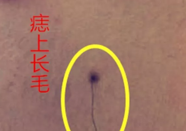 孩子長了有毛的痣怎么辦 孩子長了有毛的痣可以去掉嗎 孩子長了有毛的痣怎么辦 孩子長了有毛的痣可以去掉嗎