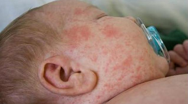 孩子身上長痱子怎么辦 如何預(yù)防寶寶夏天長痱子