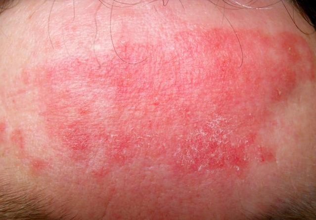 假性濕疣是什么 怎么區(qū)分假性濕疣和尖銳濕疣