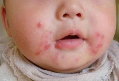 天氣濕熱怎么預防小兒濕疹 小兒濕疹怎么護理 天氣濕熱怎么預防小兒濕疹 小兒濕疹怎么護理