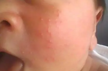 天氣濕熱怎么預防小兒濕疹 小兒濕疹怎么護理 天氣濕熱怎么預防小兒濕疹 小兒濕疹怎么護理