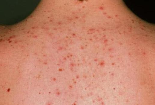 后背長痘是螨蟲嗎 后背上長痘了該怎么辦