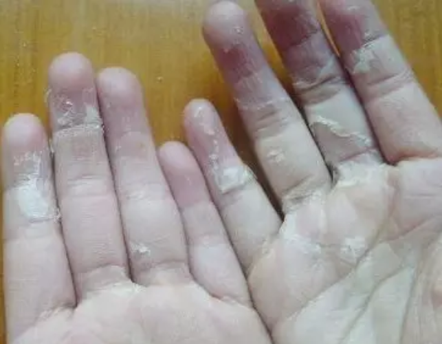 孩子手脫皮是怎么回事 孩子手脫皮怎么護(hù)理 孩子手脫皮是怎么回事 孩子手脫皮怎么護(hù)理