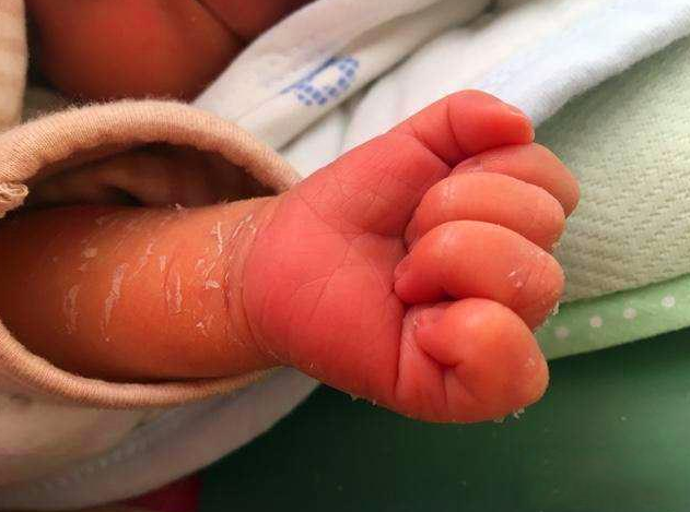 孩子手脫皮是怎么回事 孩子手脫皮怎么護(hù)理 孩子手脫皮是怎么回事 孩子手脫皮怎么護(hù)理