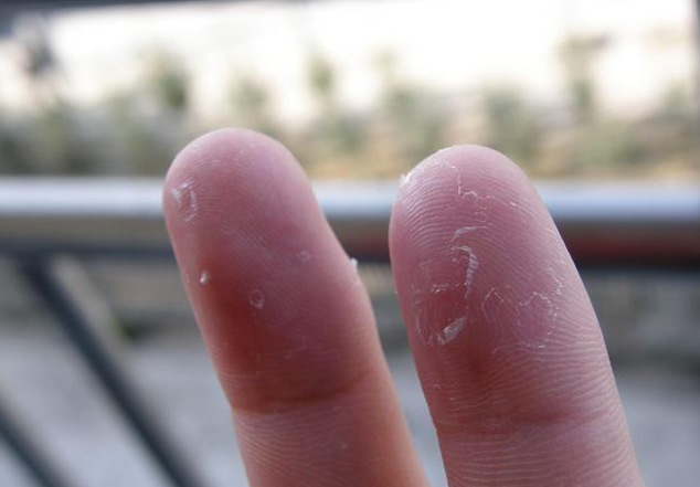 孩子手脫皮是怎么回事 孩子手脫皮怎么護(hù)理 孩子手脫皮是怎么回事 孩子手脫皮怎么護(hù)理