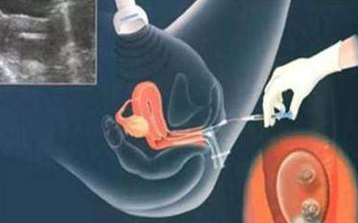 做試管嬰兒疼不疼 做試管嬰兒去哪里好