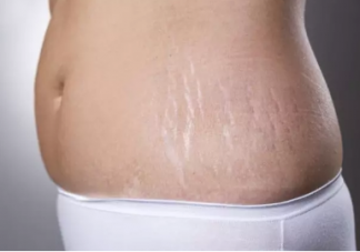 為什么女性懷孕會(huì)出現(xiàn)妊娠紋 妊娠紋怎怎么去除
