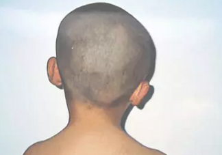 小兒斜頸是怎么回事 小兒斜頸有什么癥狀