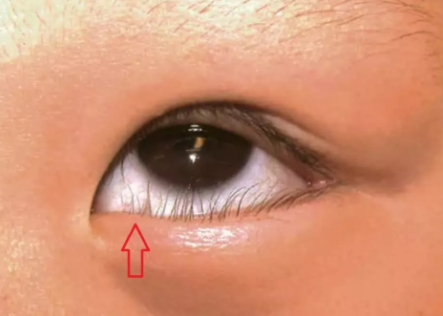 寶寶眼屎多也是病嗎 眼屎多是上火嗎 寶寶眼屎多也是病嗎 眼屎多是上火嗎