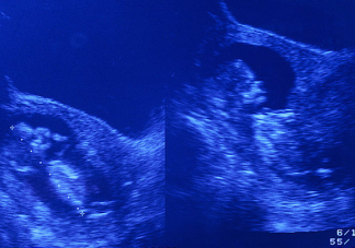 胎芽胎心什么時(shí)候出現(xiàn) 胎芽胎心最晚何時(shí)出現(xiàn)