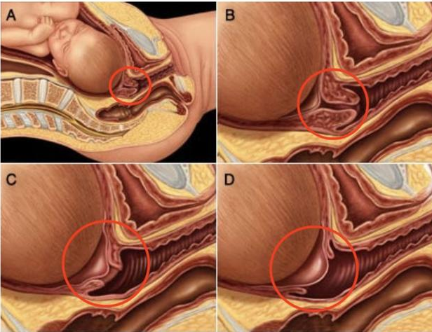 宮頸管消失是什么意思 宮頸管消失后多久分娩