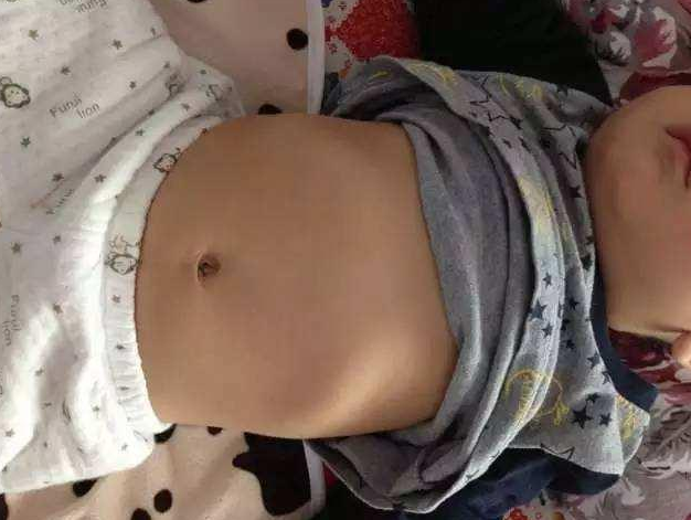 寶寶肋骨外翻就是缺鈣嗎 怎么預(yù)防寶寶肋骨外翻 寶寶肋骨外翻就是缺鈣嗎 怎么預(yù)防寶寶肋骨外翻