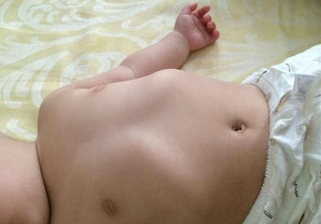 寶寶肋骨外翻就是缺鈣嗎 怎么預(yù)防寶寶肋骨外翻 寶寶肋骨外翻就是缺鈣嗎 怎么預(yù)防寶寶肋骨外翻