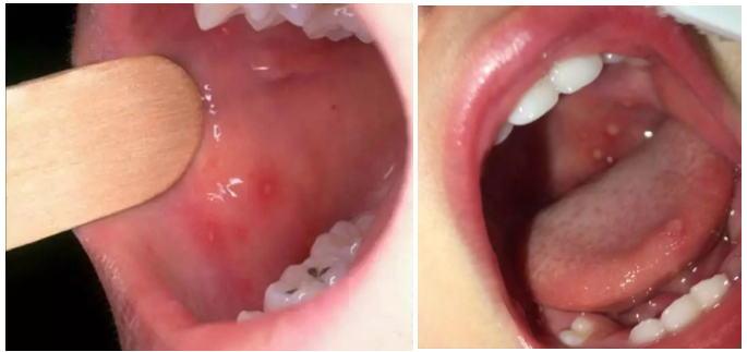 皰疹性咽峽炎和手足口病有什么不同 手足口病和皰疹性咽峽炎這兩個病很嚴重嗎