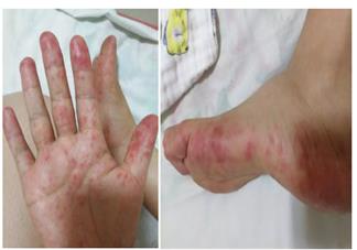 皰疹性咽峽炎和手足口病有什么不同 手足口病和皰疹性咽峽炎這兩個病很嚴重嗎