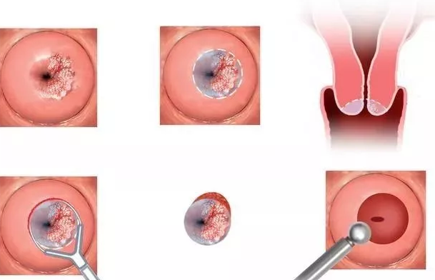 宮頸糜爛會(huì)變成宮頸癌嗎 有癥狀的宮頸糜爛怎么處理 宮頸糜爛會(huì)變成宮頸癌嗎 有癥狀的宮頸糜爛怎么處理