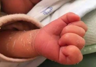 新生兒身上褪皮是怎么回事 新生兒起皮怎么辦