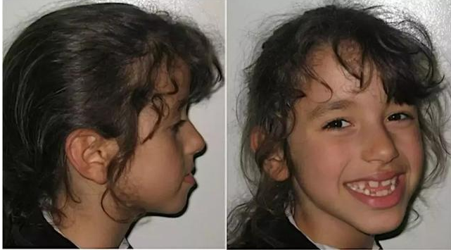 孩子牙齒地包天是怎么形成的 牙齒地包天怎么預防和治療 孩子牙齒地包天是怎么形成的 牙齒地包天怎么預防和治療