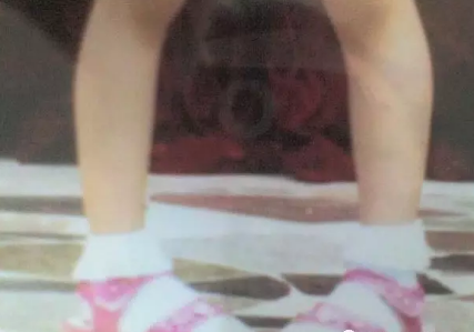 孩子走路內(nèi)八字是骨骼有問題嗎 孩子走路內(nèi)八字該怎么糾正