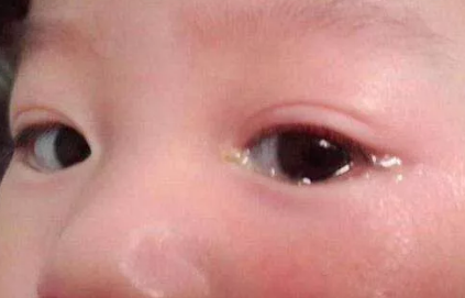 剛出生的孩子眼屎多是不是上火了 孩子眼屎多是怎么回事