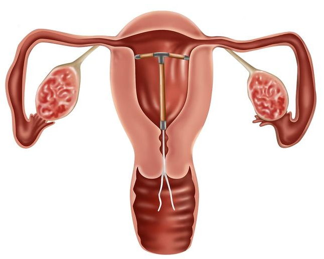 產(chǎn)后上環(huán)出現(xiàn)哪些癥狀要注意 產(chǎn)后什么時間上環(huán)比較好