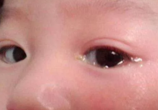 剛出生的孩子眼屎多是不是上火了 孩子眼屎多是怎么回事