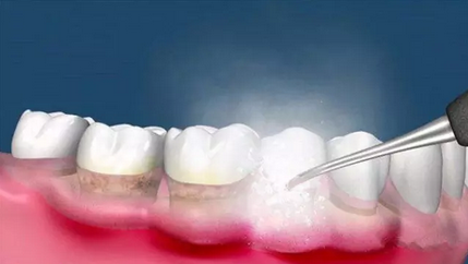 懷孕期間能洗牙補牙嗎 孕期孕婦補牙洗牙有危險嗎