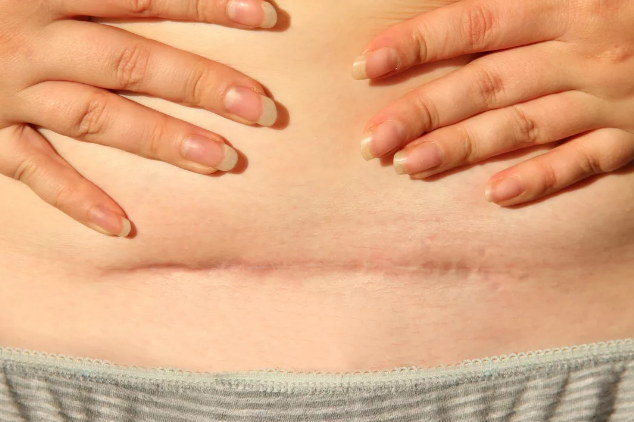 剖腹產(chǎn)后的疤痕是不是一定會(huì)增生 剖腹產(chǎn)后的疤痕如何改善