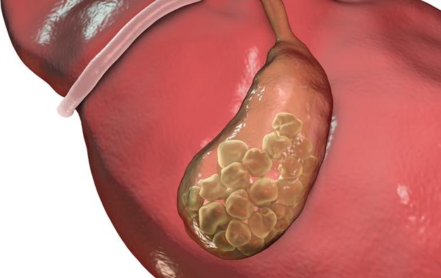 孕婦容易得膽結(jié)石嗎 懷孕得了膽結(jié)石會(huì)有些哪些危害 孕婦容易得膽結(jié)石嗎 懷孕得了膽結(jié)石會(huì)有些哪些危害
