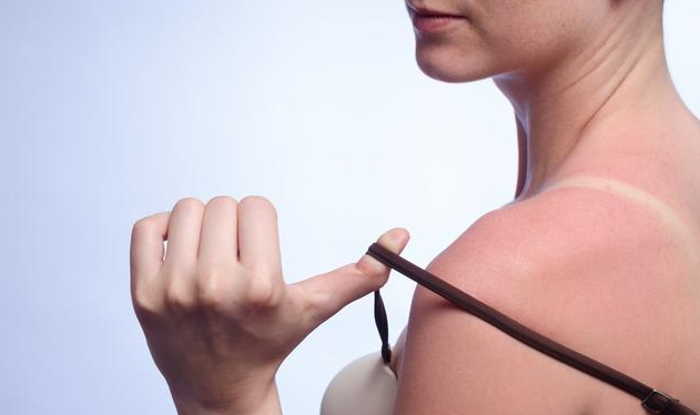 夏季曬傷處理小妙招 夏季如何正確防曬