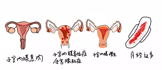 上曼月樂環不來月經正常嗎 上曼月樂環月經量減少有影響嗎