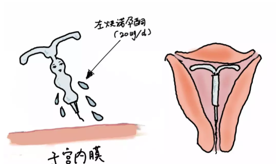 上曼月樂環(huán)后子宮會越來越大嗎 上曼月樂環(huán)對子宮影響