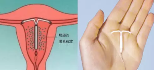 上曼月樂環(huán)會臉上長痘嗎 曼月樂環(huán)孕激素會引起長痘嗎