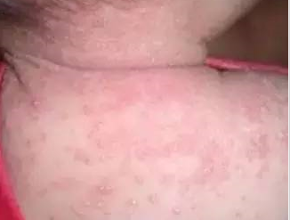 寶寶長(zhǎng)痱子為什么不能用痱子粉 寶寶長(zhǎng)痱子了該怎么辦