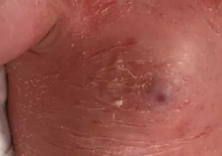 新生兒蛻皮是怎么回事 寶寶蛻皮可以擦什么護(hù)理