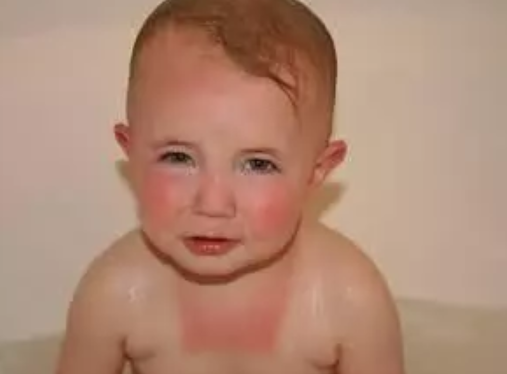 小孩額頭鼻子輕度曬傷用什么藥 小孩輕度曬傷脫皮怎么辦