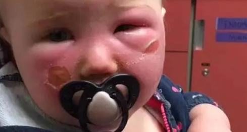 小孩曬出水泡了怎么辦 小孩曬了一天嚴(yán)重曬傷