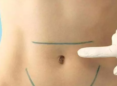 剖腹產橫切口和豎切口有什么區別 橫切口和豎切口哪個比較好 剖腹產橫切口和豎切口有什么區別 橫切口和豎切口哪個比較好