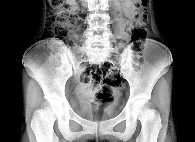 盆腔積液和盆腔炎有什么關系 B超顯示盆腔積液怎么回事