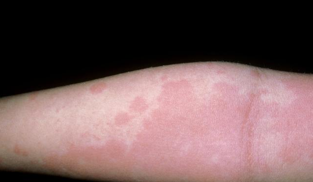 孕婦蕁麻疹會遺傳給寶寶嗎 孕婦得了蕁麻疹怎么護理