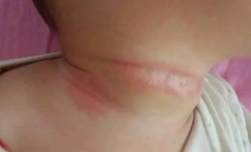 寶寶淹脖子可以用爽身粉嗎 寶寶淹脖子用爽身粉護理好不好