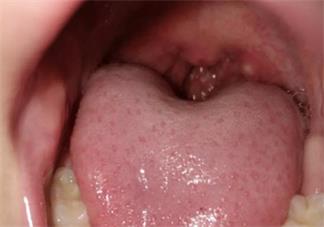 皰疹性咽頰炎怎么給孩子推拿恢復(fù) 如何調(diào)理皰疹性咽頰炎的孩子