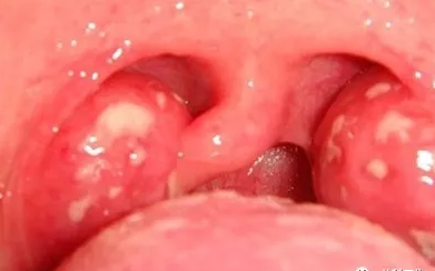 寶寶為什么會患得扁桃體炎 寶寶扁桃體發炎怎么應對