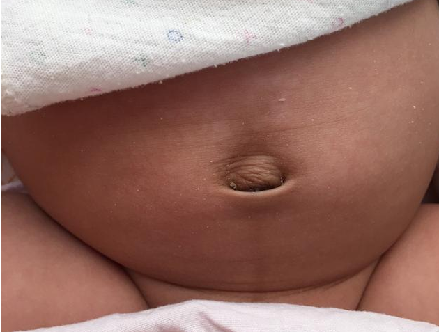 寶寶肚臍鼓包是怎么回事 寶寶臍疝護理方法