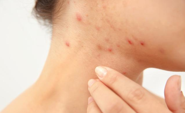 超6成大學生受青春痘困擾 長青春痘怎么調理