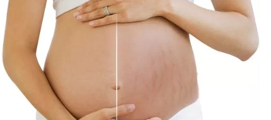 這些孕婦不容易長妊娠紋 哪些人不容易長妊娠紋