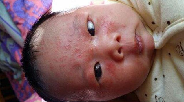 如何區分痱子和濕疹 痱子濕疹混合怎么辦