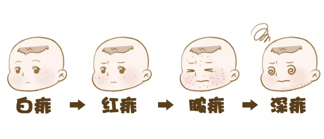 孩子長痱子怎么用推拿去痱 給孩子去痱推拿手法