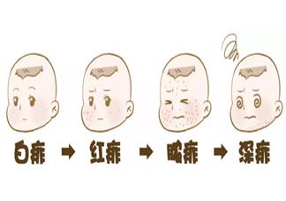 孩子長痱子怎么用推拿去痱 給孩子去痱推拿手法