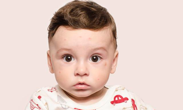 寶寶被蚊子咬了怎么止癢比較好 這些錯誤止癢方法要避免